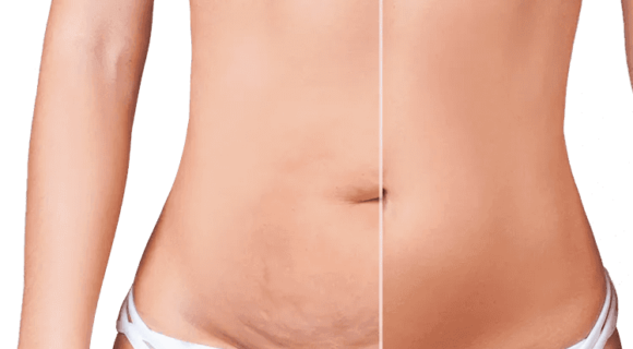 Body Contouring before and after