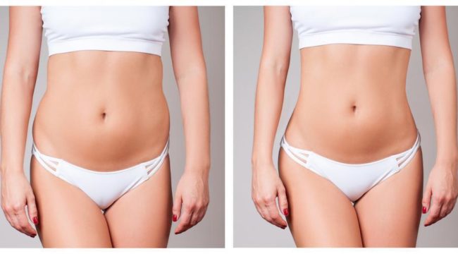 body contouring results
